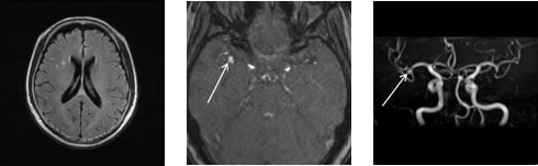 MRI頭部・MRA