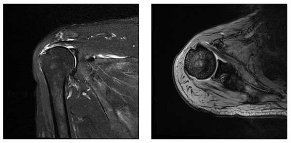 MRI左肩関節
