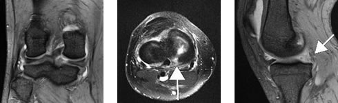 膝関節MRI：