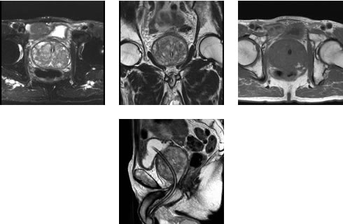 MRI前立腺
