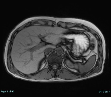 腹部MRI