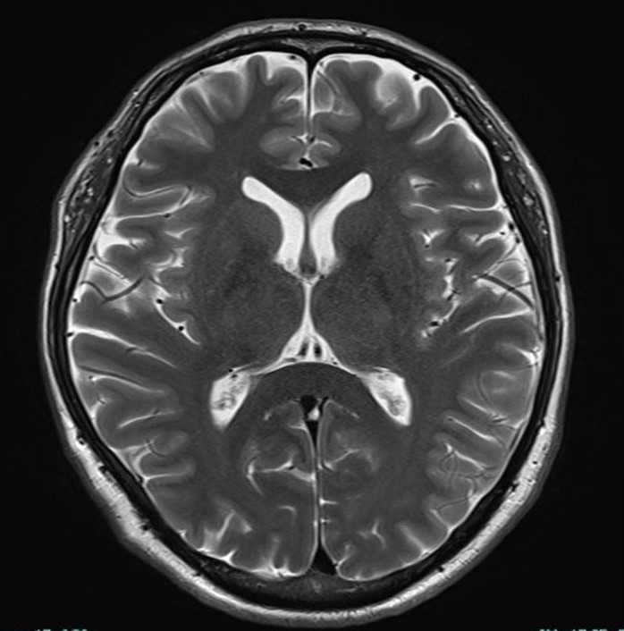 頭部MRI：T2強調画像(正常)