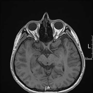 眼窩MRI