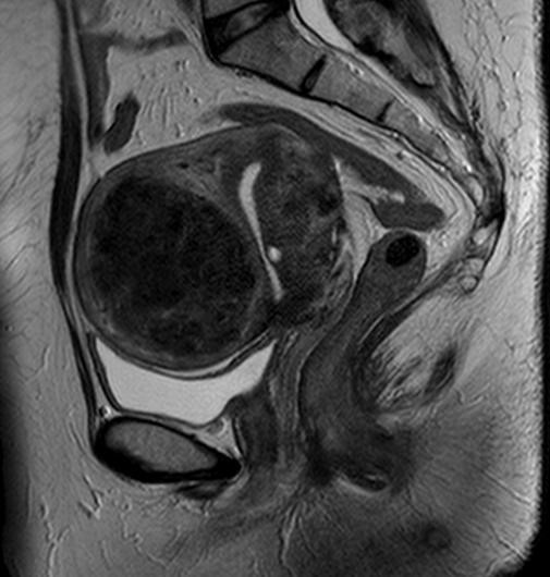 女性骨盤MRI(子宮筋腫)