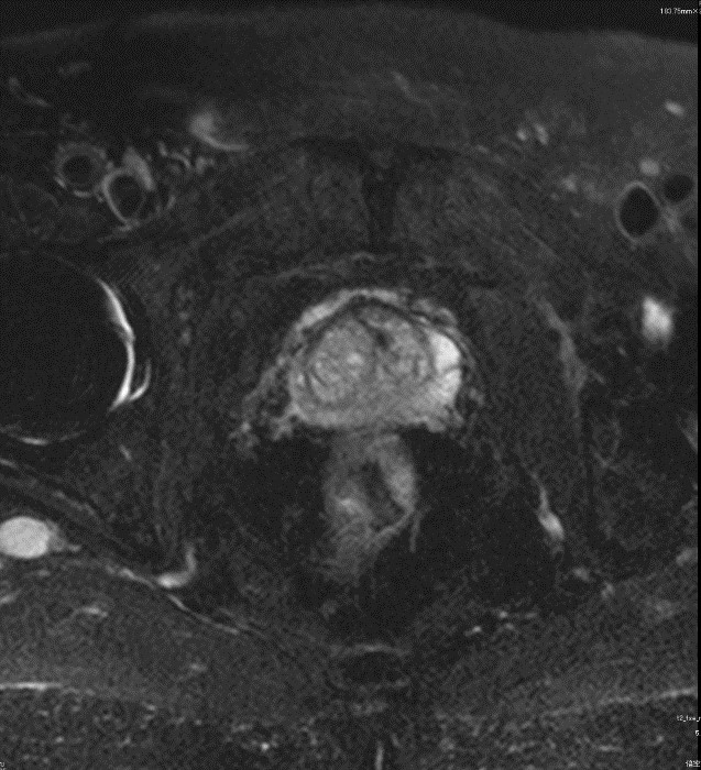男性骨盤MRI(前立腺)