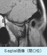 Sagtal画像（閉口位）