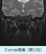 Cornal画像（閉口位）