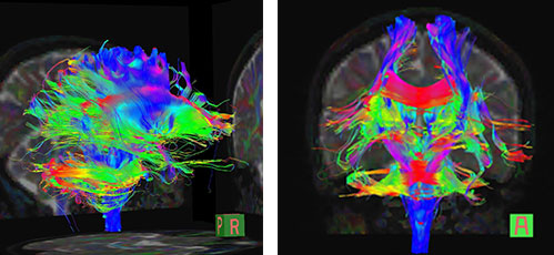 頭部　DTI tractography