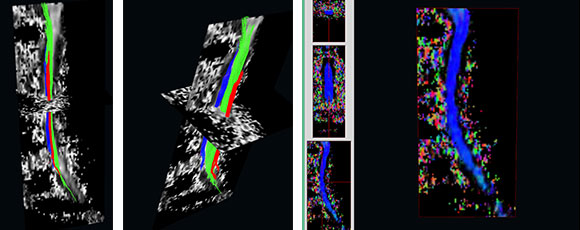 頚部　tractography