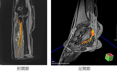 関節 tractography