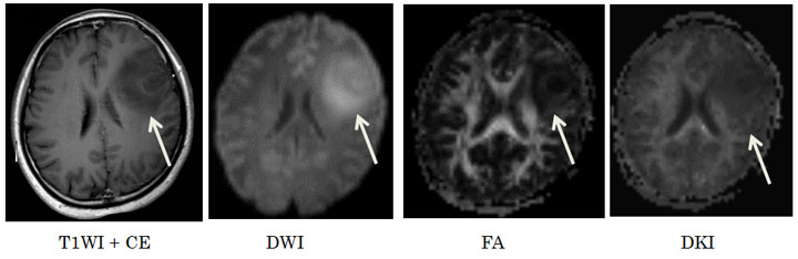 Diffusional kurtosis imaging (DKI)