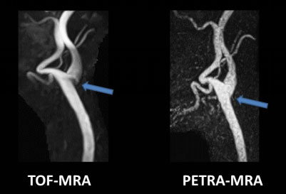 PETRAを使用した頚部MRA