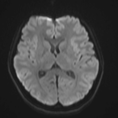 DWI(拡散強調画像)