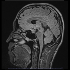 矢状断(Sagittal)