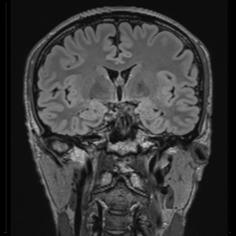 冠状断(Coronal)