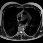 胸部MRI